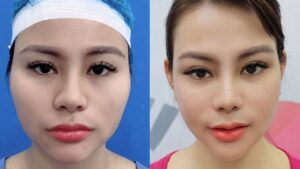 Jaw Reduction Recovery: How Long and How to Speed It Up