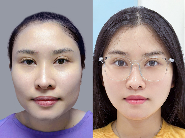A slender chin helps the face look younger