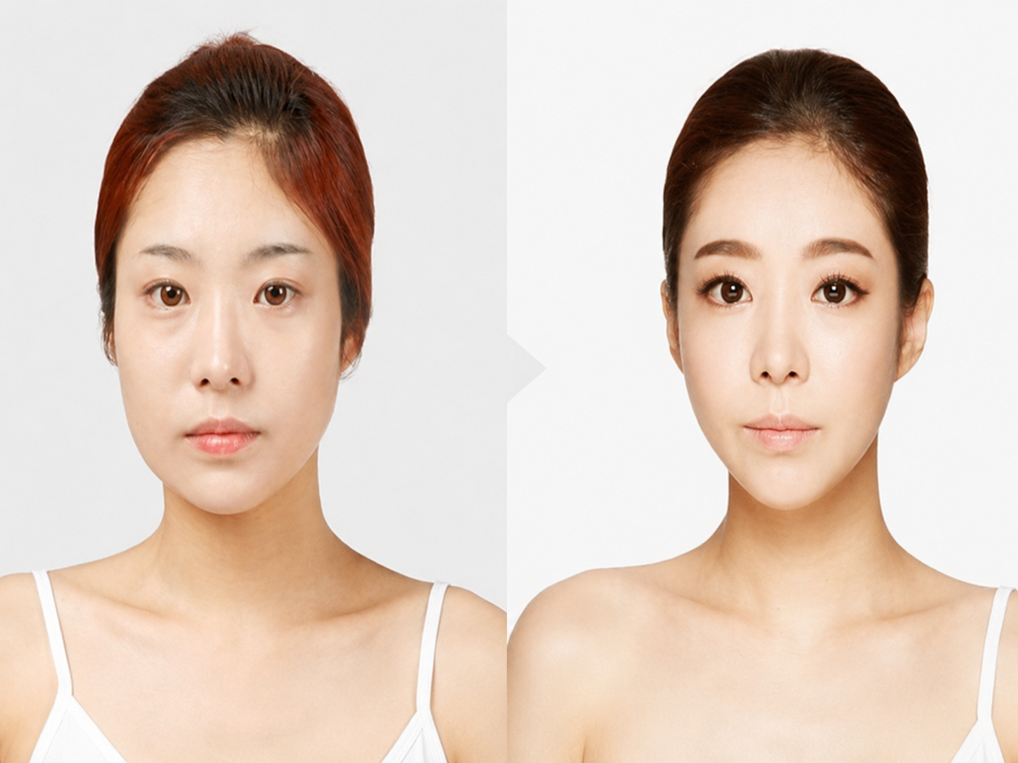 Jaw-reduction botox injections must be performed by highly qualified doctors