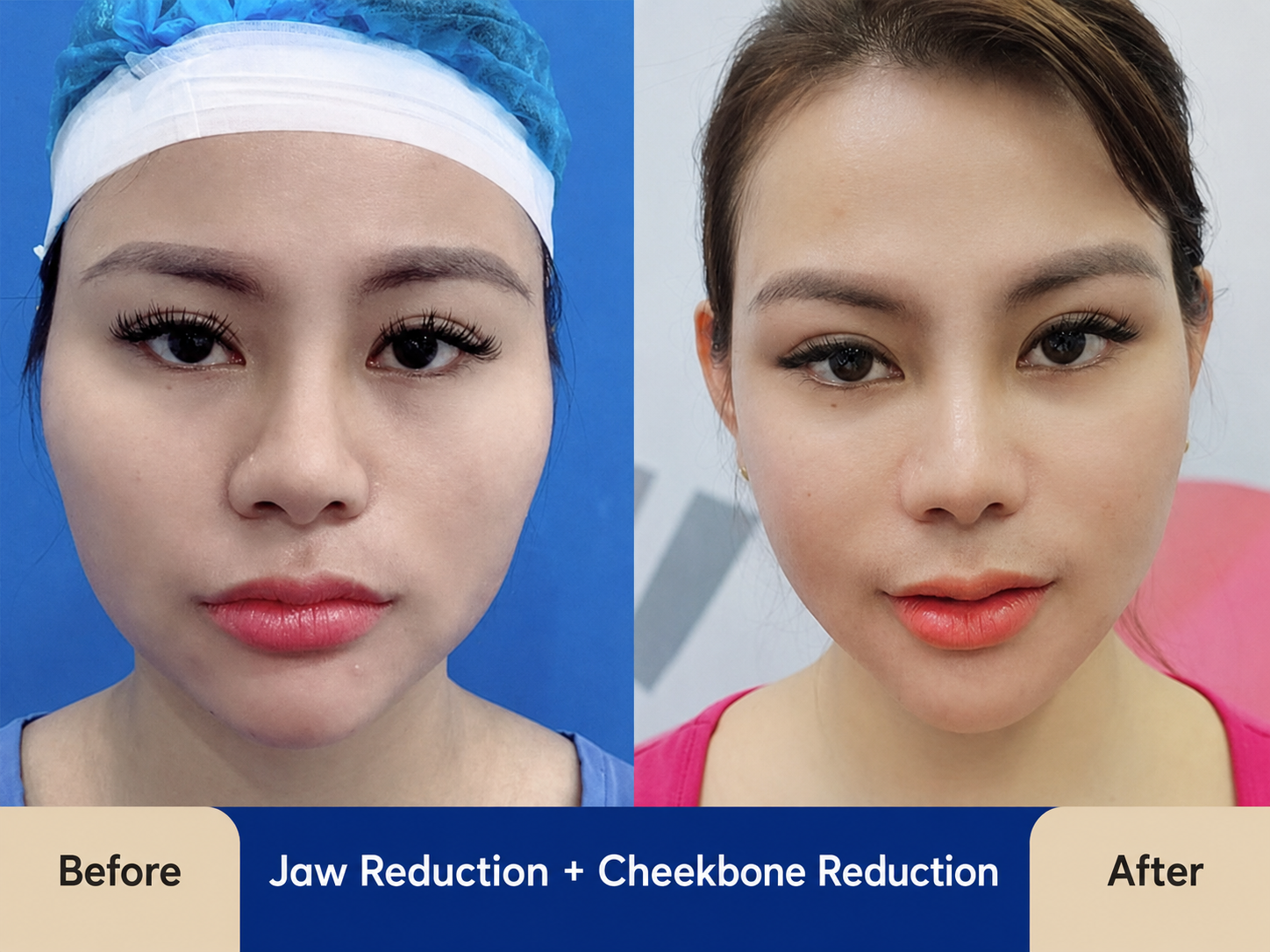 Jaw reduction surgery requires 2 to 3 weeks of downtime and recovery
