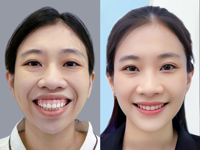 Safe and minimally painful orthognathic surgery for gummy smile correction