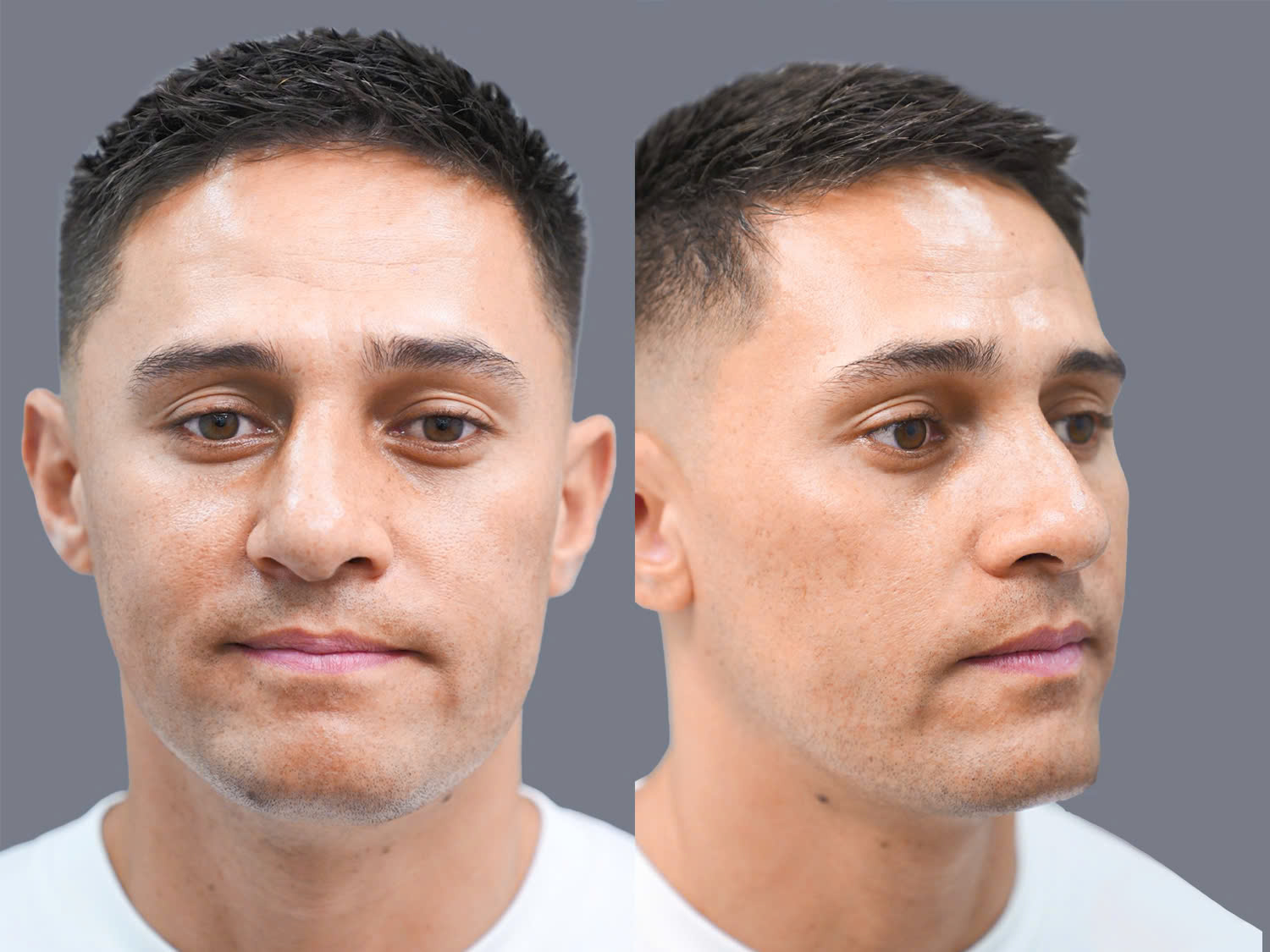 Lemusu suffered an accident 15 years ago, resulting in a broken, humped nasal bridge. 