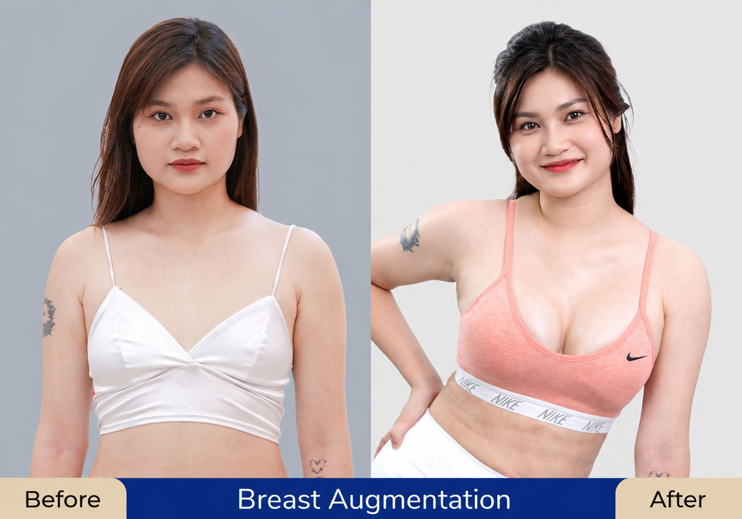 Australian overseas Vietnamese possessing an alluring bustline after breast augmentation at Kangnam