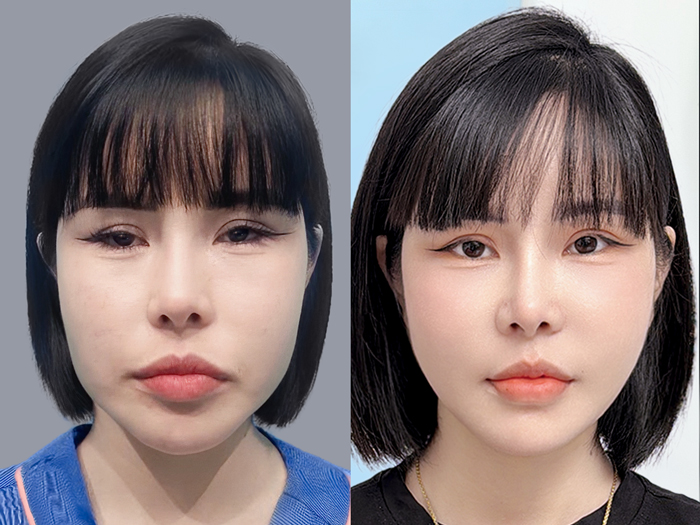 Surgery to create an oval face reflecting standard East Asian beauty