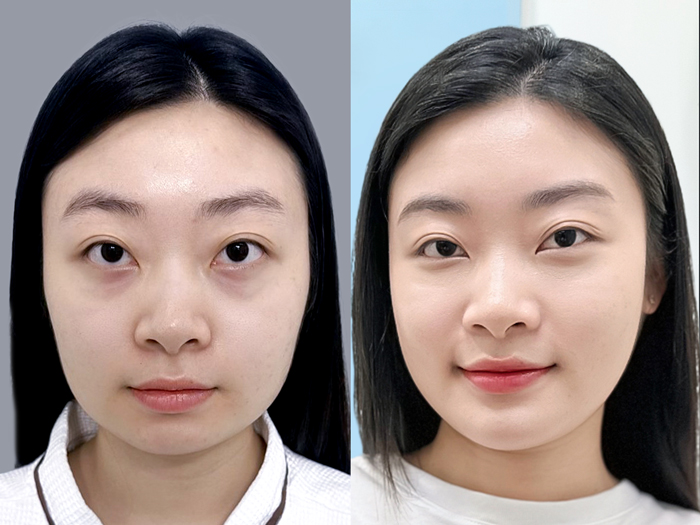Surgery to create an oval face reflecting standard East Asian beauty