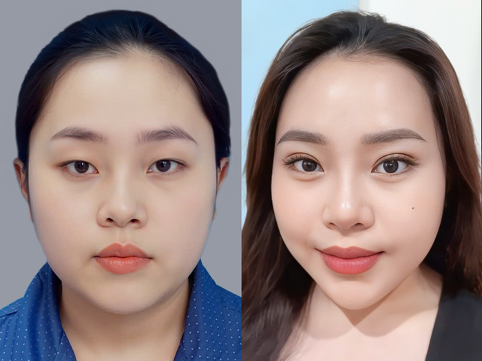 Client achieving a more youthful face following eyelid correction