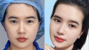 Plasma Eyelid Surgery: How It Works and Who It Suits