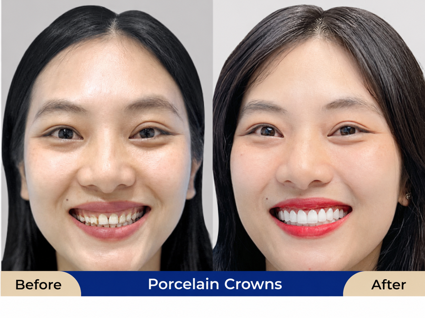 Porcelain crowns improve yellowed, uneven teeth