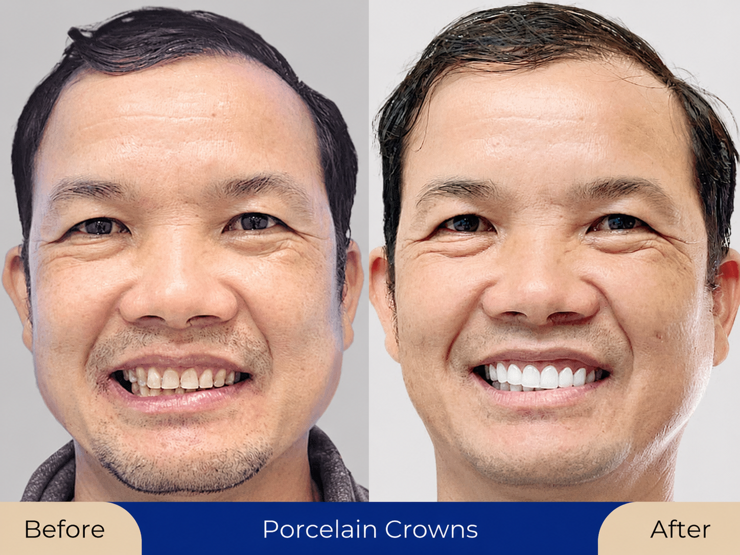 Client before and after porcelain crowns at Kangnam