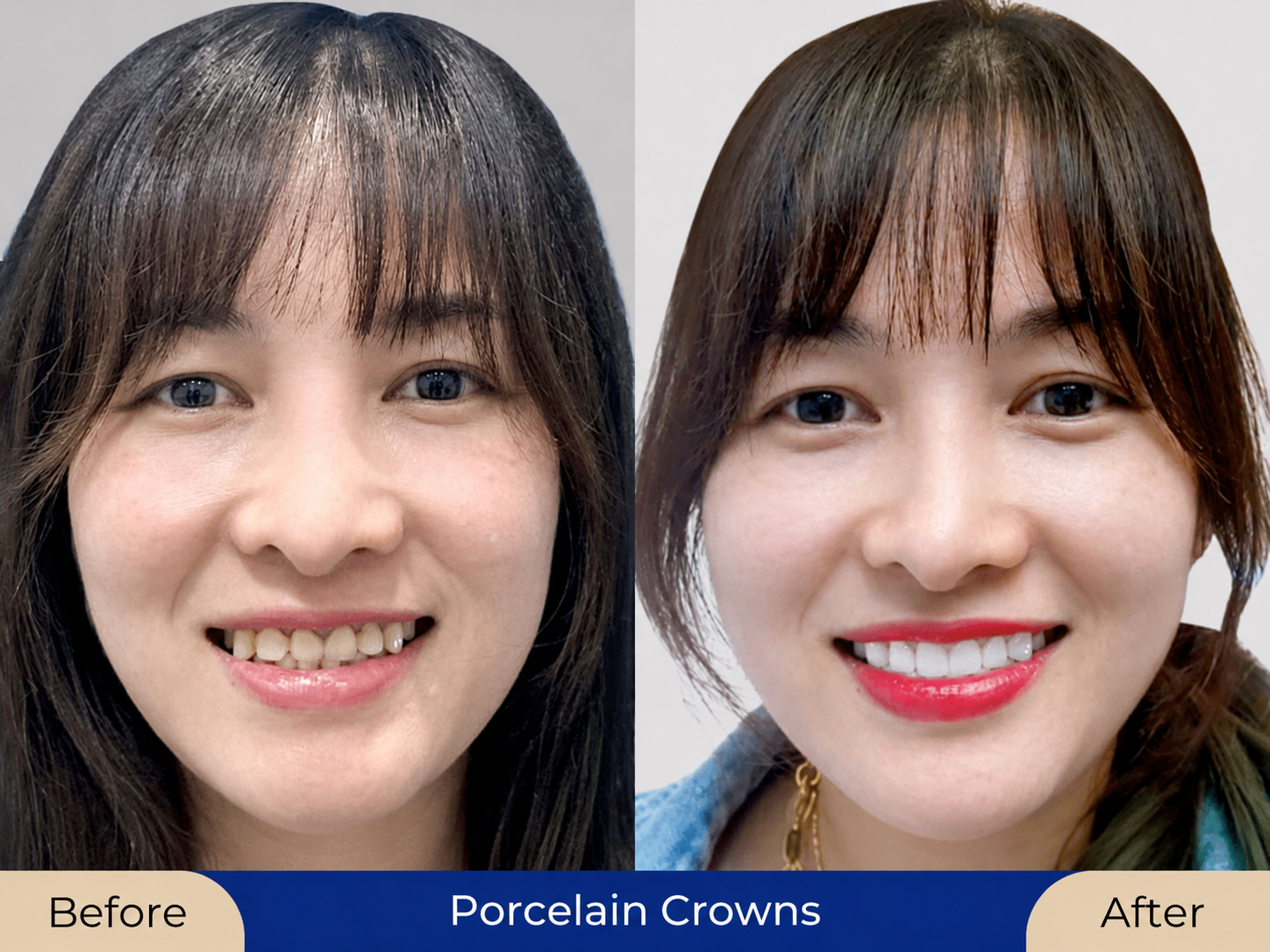 Porcelain crowns offer long-lasting durability