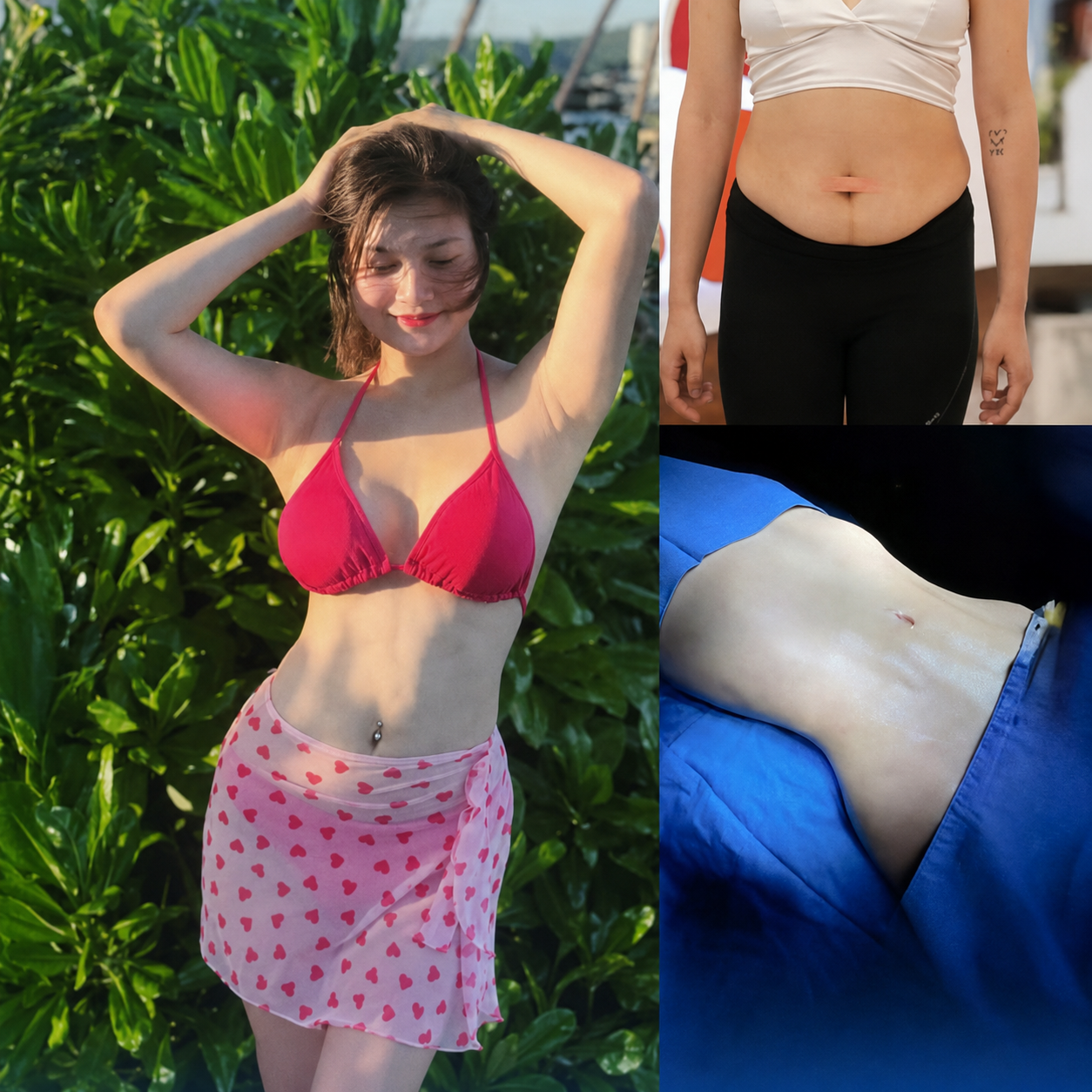 If the C-section wound heals early, mothers can consider early abdominal liposuction