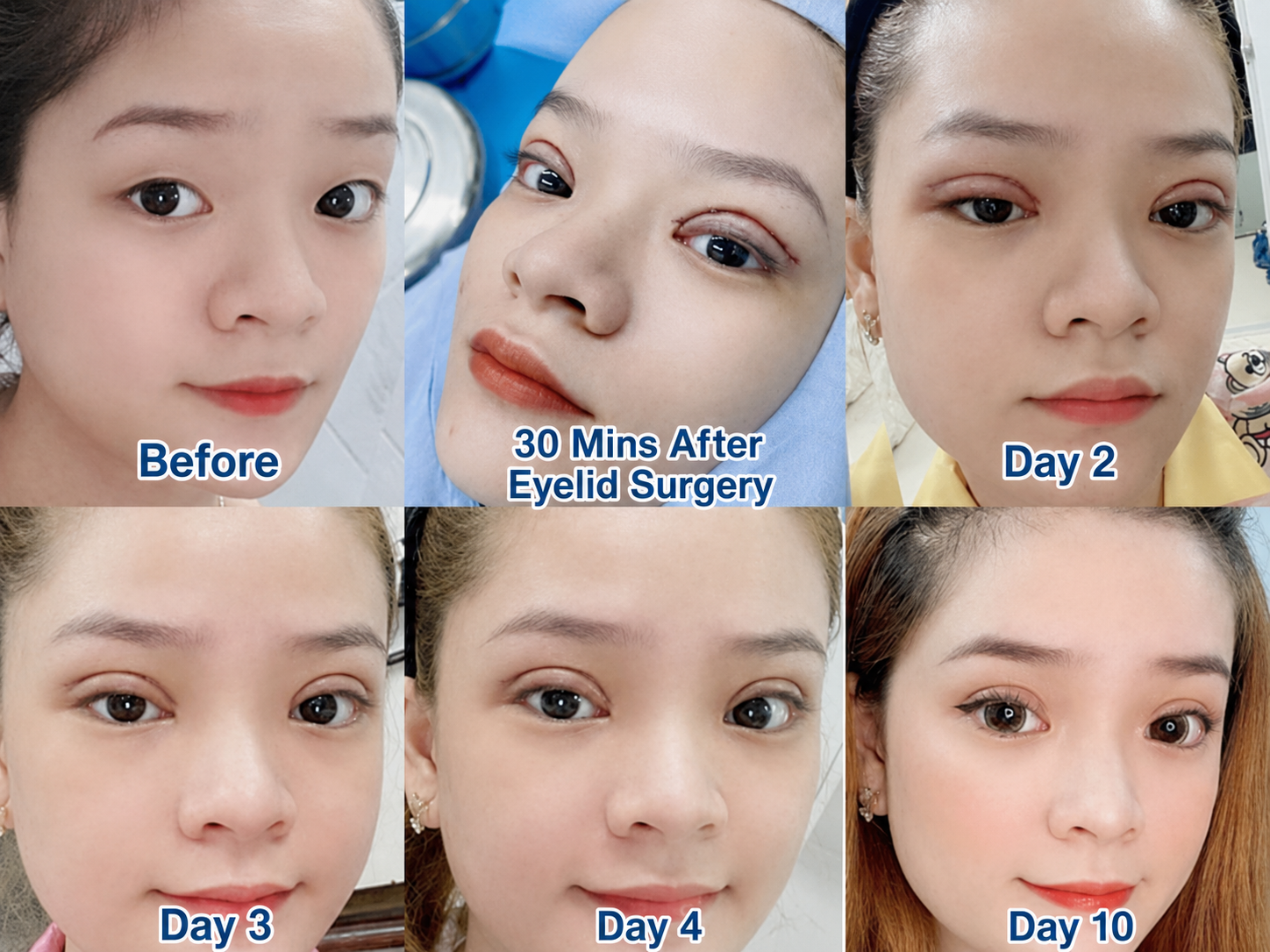 Clients achieve natural results 10 days after Plasma eyelid correction at Kangnam