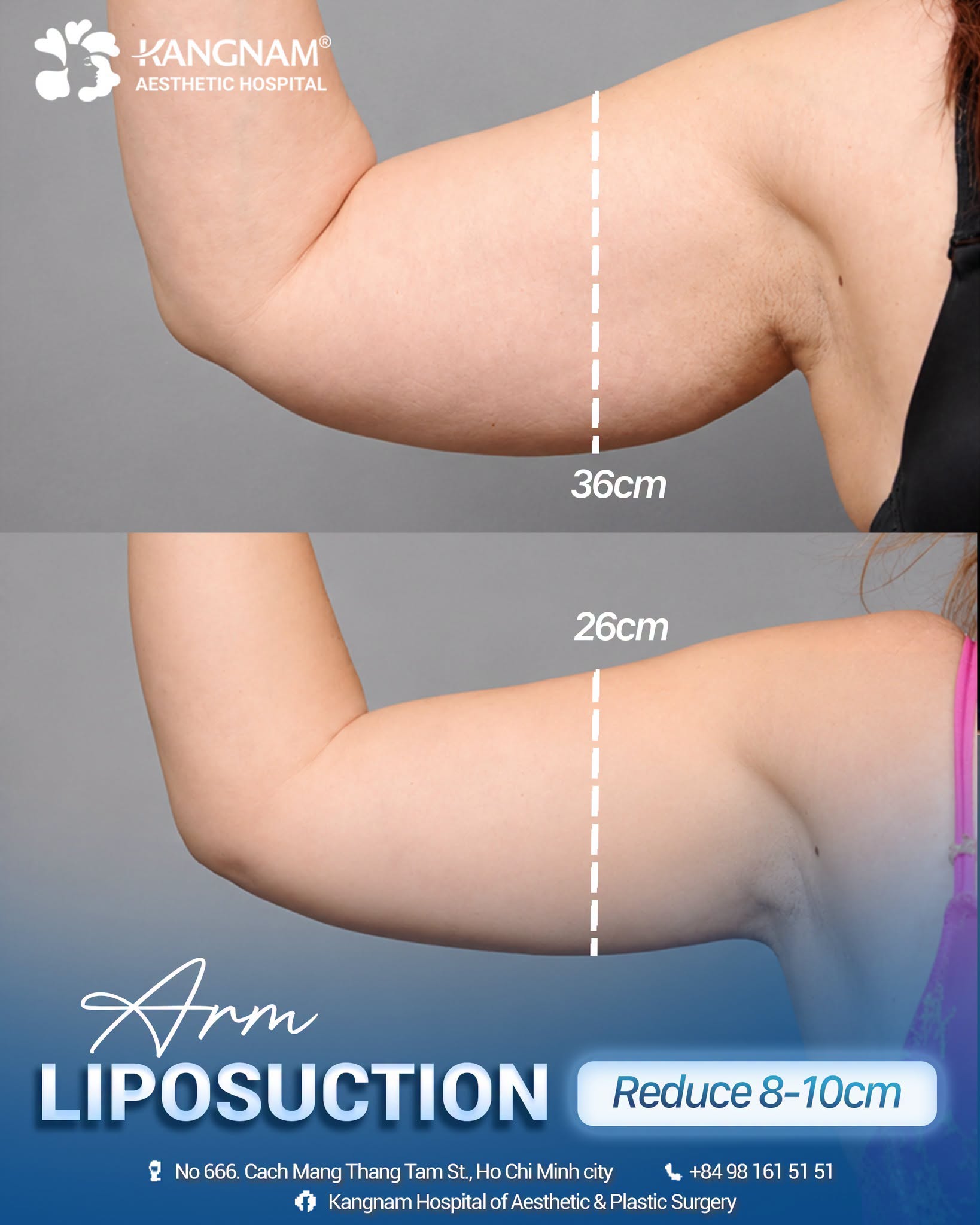 Vaser spray arm liposuction is a quick way to remove excess fat Slender and firm arms