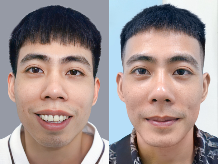 Orthognathic surgery effectively corrects gummy smiles and enhances aesthetics