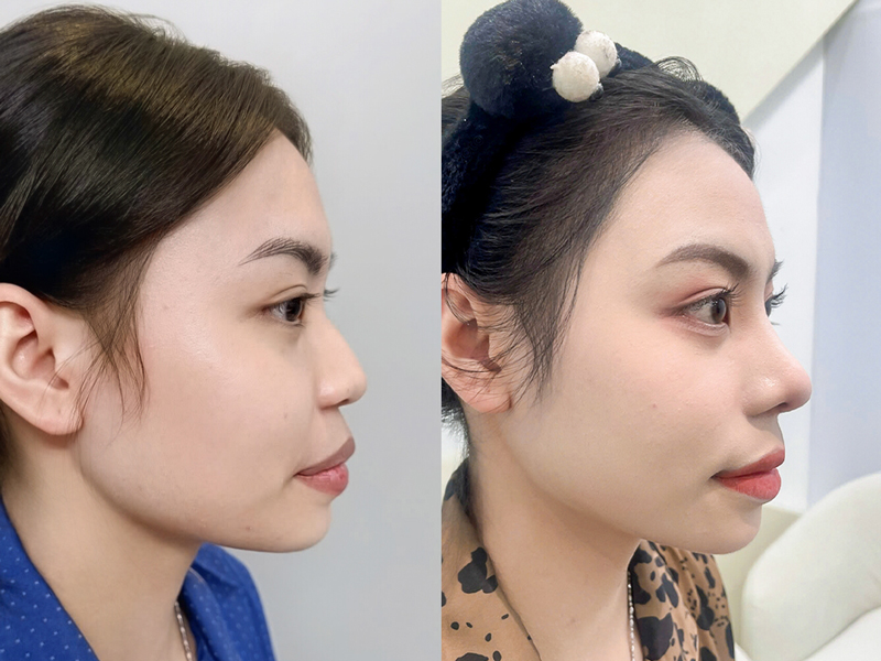 Natural-looking rhinoplasty results that harmonize with the face. 