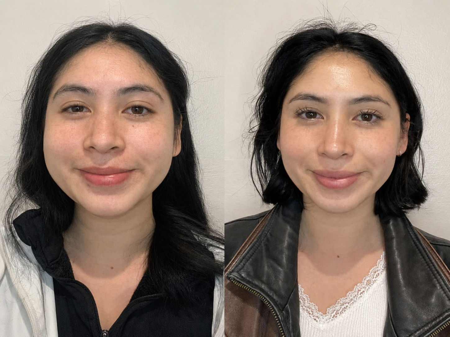 The jaw-slimming botox procedure
