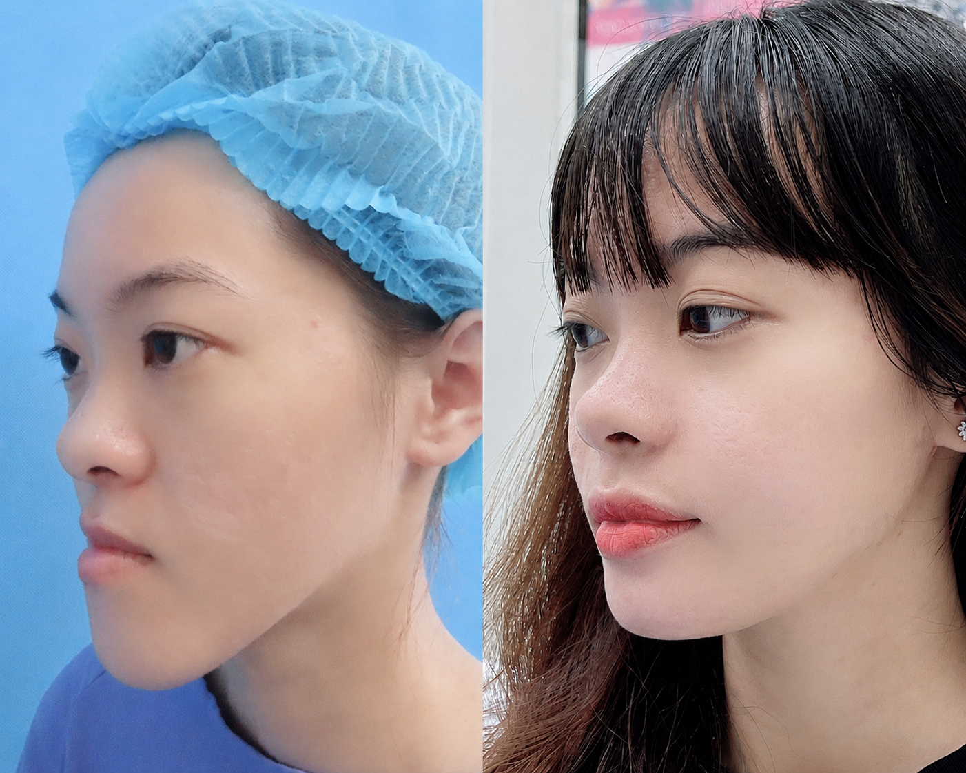 Concave face surgery