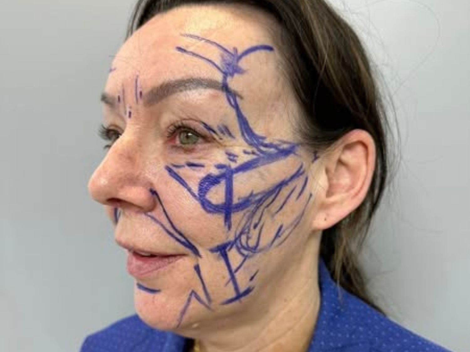 The customer marks the areas requiring surgery. 
