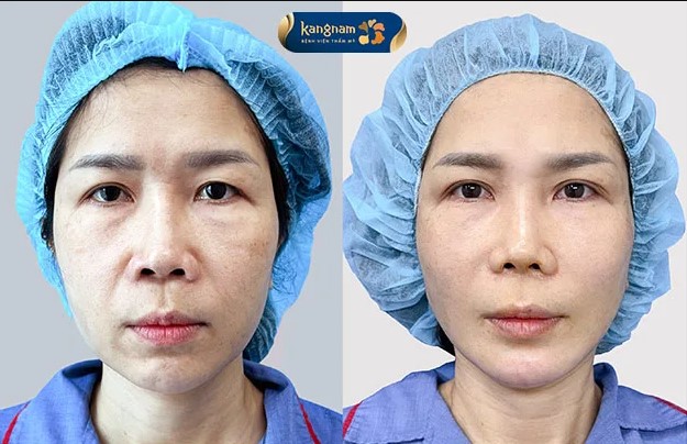 After a collagen thread lift, the skin recovers within 5 to 7 days.