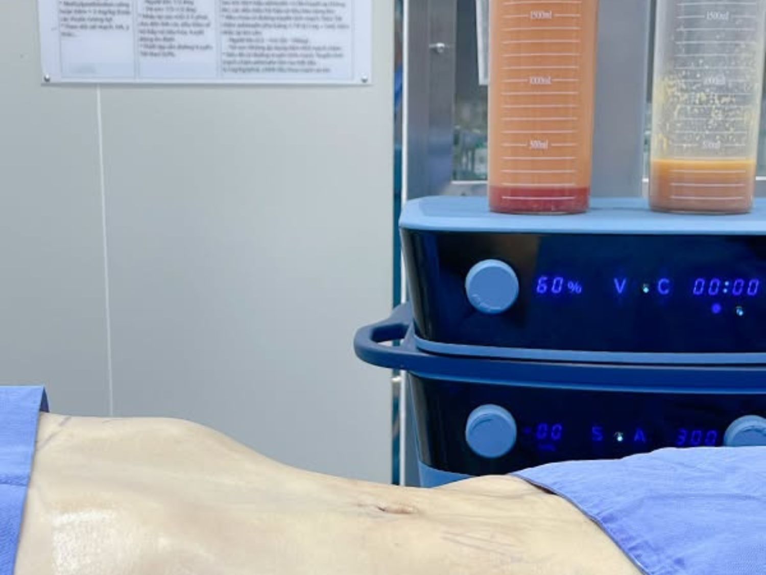 Vaser spray fat reduction quickly and safely eliminates excess fat.