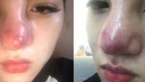 7 Warning Signs of Infection After Rhinoplasty & Timely Medical Protocols