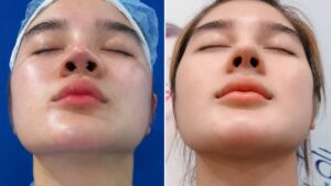 A Lump Inside the Nostril After Rhinoplasty: What It Means