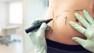 Abdominal Skin Tightening: Firming Loose Belly Skin