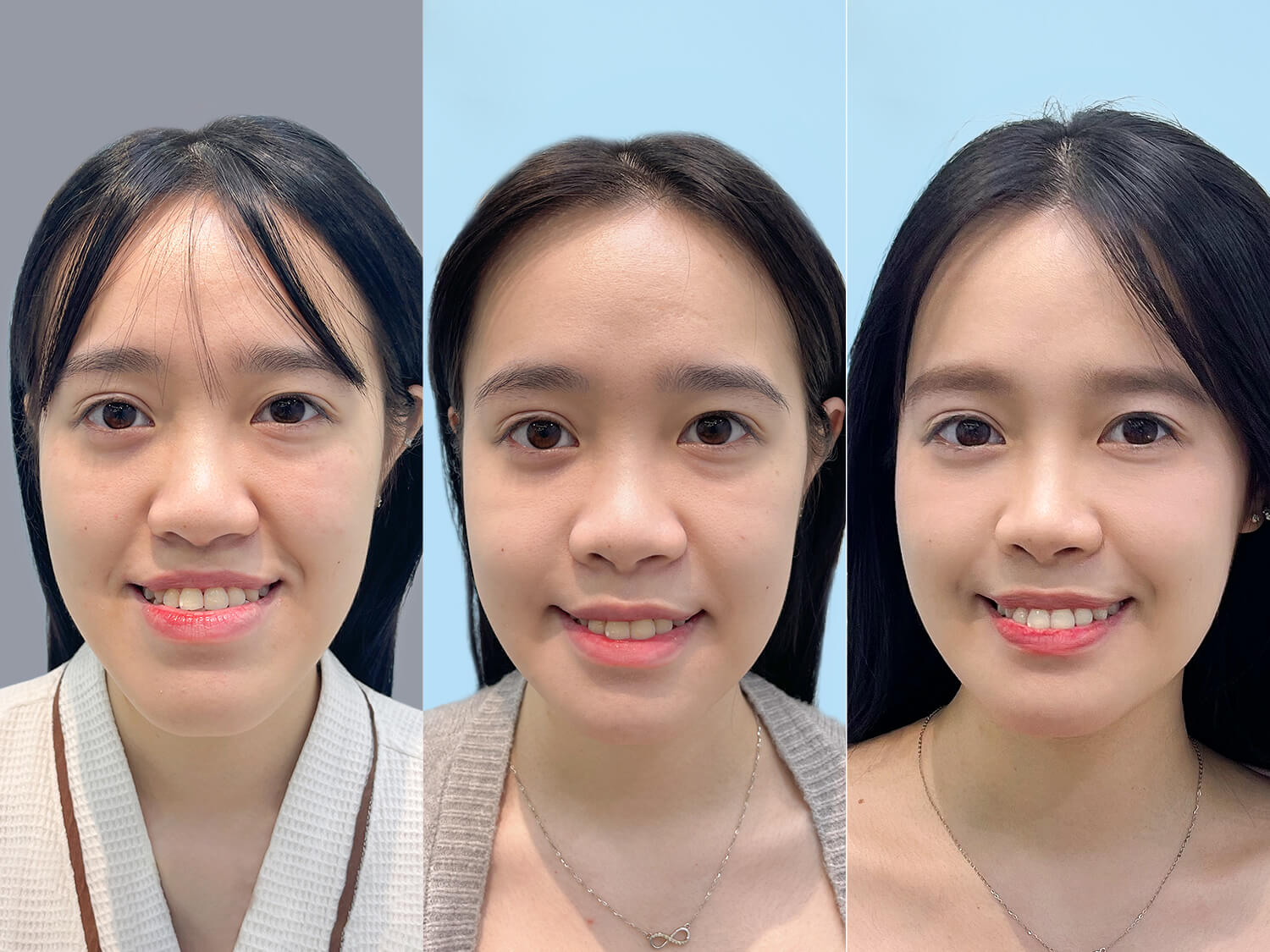 Phẫu thuật chỉnh hàm giúp khắc phục các khiếm khuyết vùng hàm mặt.