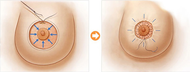 Women with large areolas that are disproportionate to the breasts