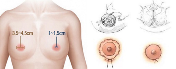 Areola reduction is performed to address excessively large areolas