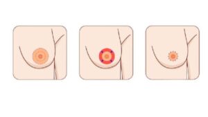 Areola Reduction Surgery: For Smaller, Balanced Areolas