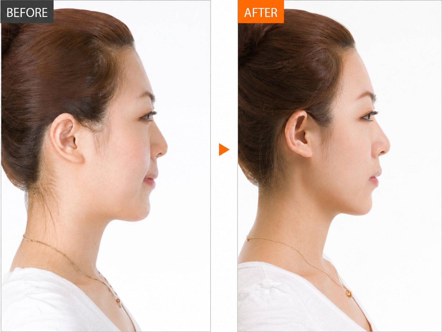 Understanding aesthetic forehead filling surgery