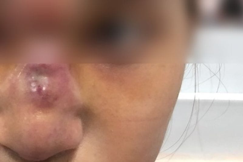 Severe infection and tissue necrosis after thread rhinoplasty.