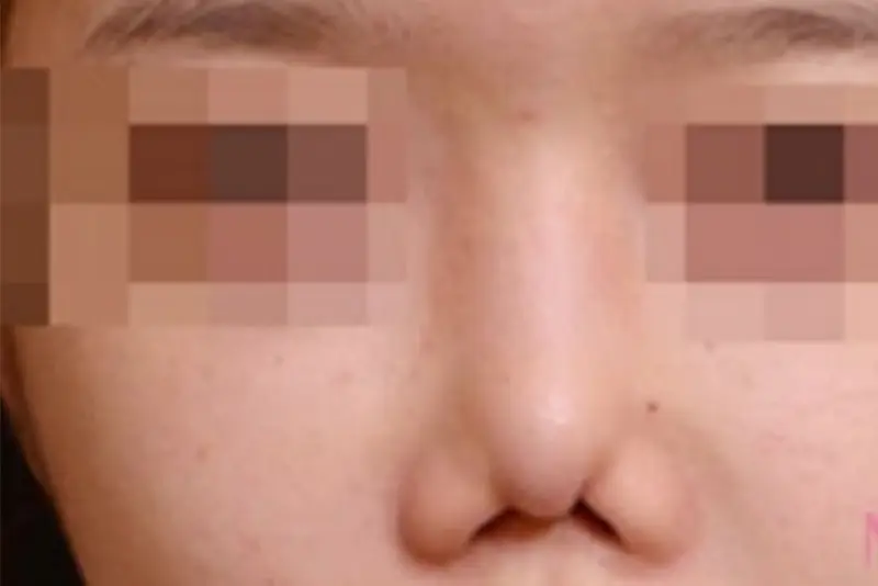 Thread rhinoplasty carries potential risks of complications.