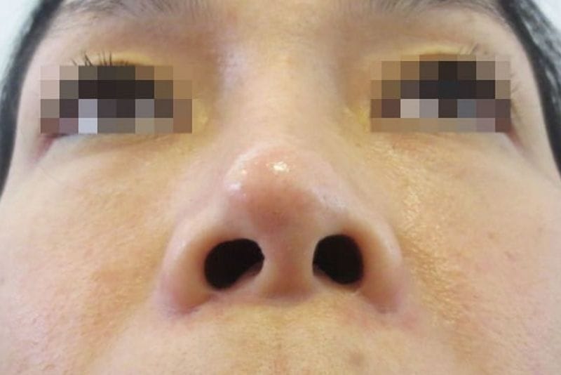 Lồi sụn do bác sĩ cắt gọt sụn thiếu chính xác