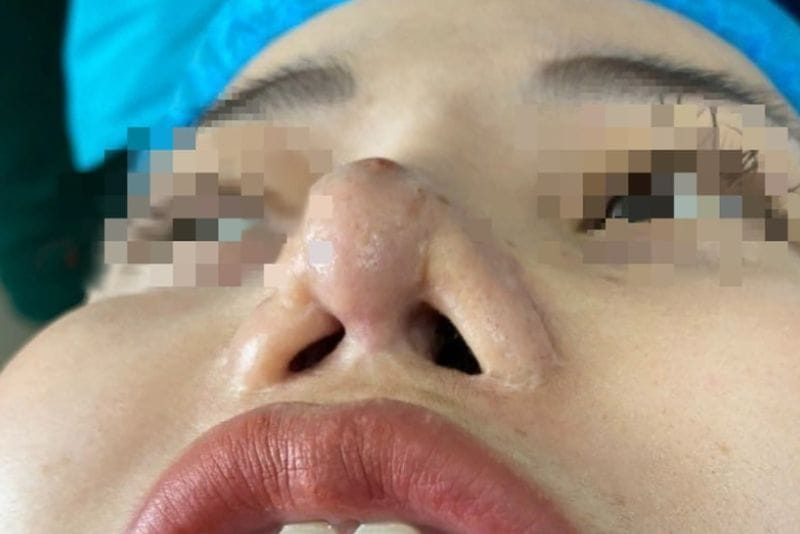 Biến chứng sụn cong vênh, lồi sụn