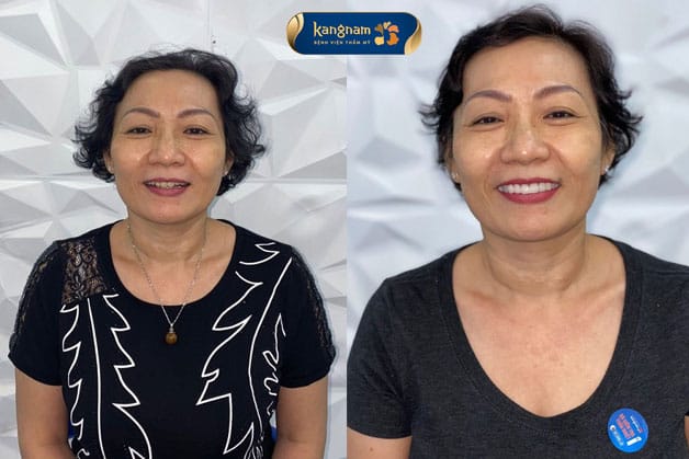 Tự tin với nụ cười rạng rỡ nhờ hàm răng đều, đẹp