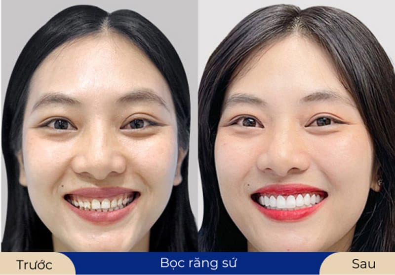 Khách hàng bọc răng sứ tại Kangnam, sở hữu hàm răng đều, trắng sáng