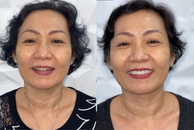 The Cercon crown procedure at Kangnam is performed safely and effectively.