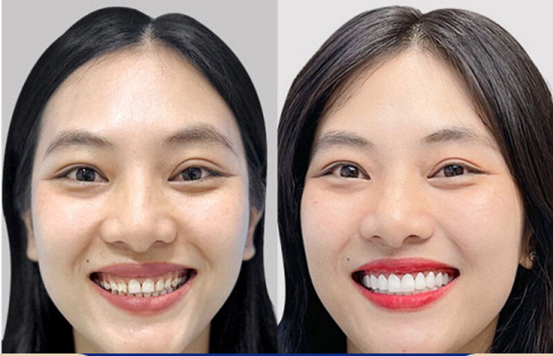 Beautiful, precisely fitted porcelain crown results that are maintained over the long term.