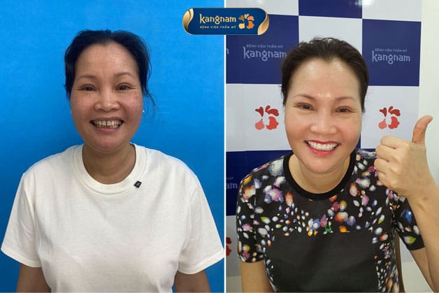 Khách hàng bọc răng sứ sở hữu hàm răng trắng sáng tự nhiên