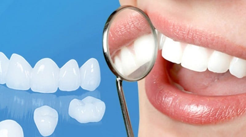 Bọc răng sứ sử dụng chất liệu bằng sứ để phục hình răng