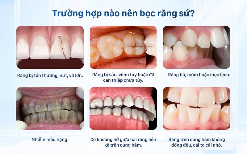 Những trường hợp nên thực hiện bọc răng sứ như răng tổn thương, răng sâu, hô, móm
