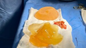 Breast Augmentation Complications and Warning Signs