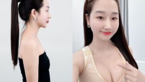 How Is Breast Augmentation Performed? Step by Step