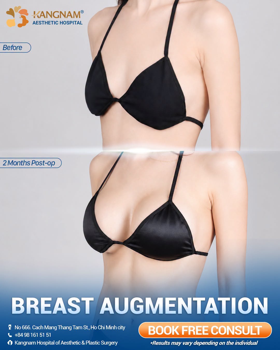Clients trust returning to Vietnam for breast augmentation