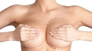 Breast Revision Surgery: Correcting a Previous Augmentation