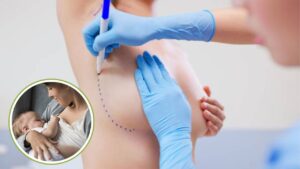 Can You Breastfeed After Breast Augmentation?