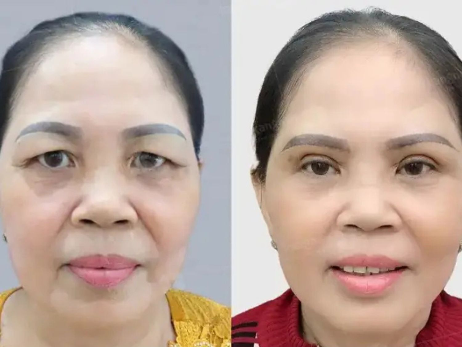 Eyelid muscle lifting helps maintain youthful vitality