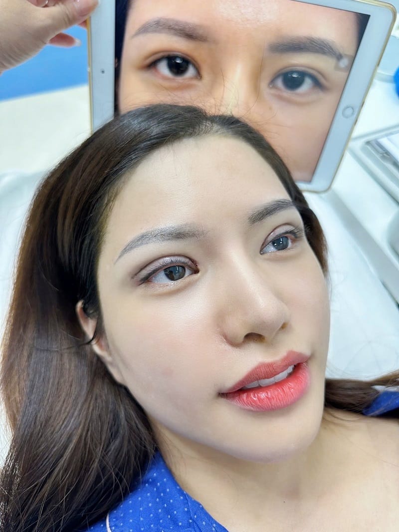 Swelling and bruising are common during early recovery after eyelid surgery.